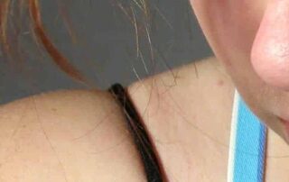 Sudden Hair Loss in Women