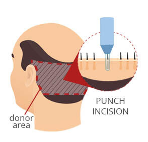 FUE Punch Incision at donor area