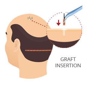 FUT Graft Insertion