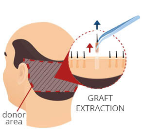 FUE Graft Extraction