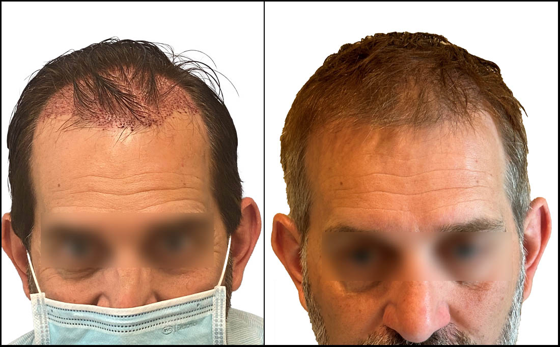 NY Hair Transplant Before and After_Male 10 NY Hair Transplant Before and After