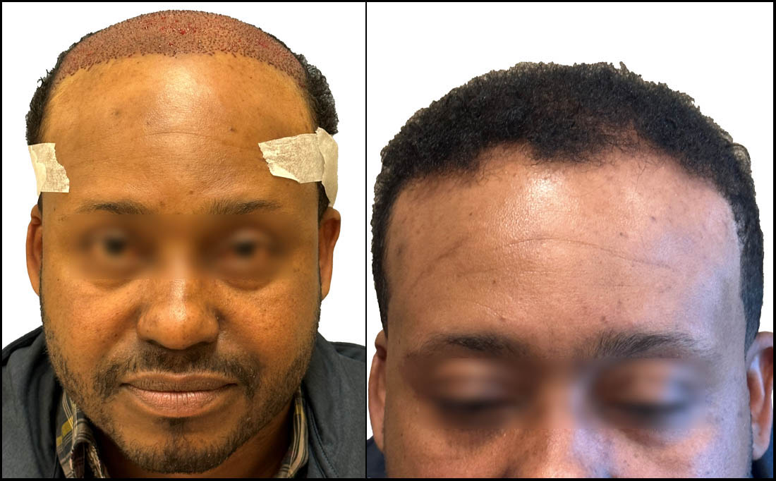 NY Hair Transplant Before and After_Male 11 NY Hair Transplant Before and After