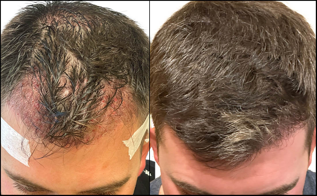 NY Hair Transplant Before and After_Male 12