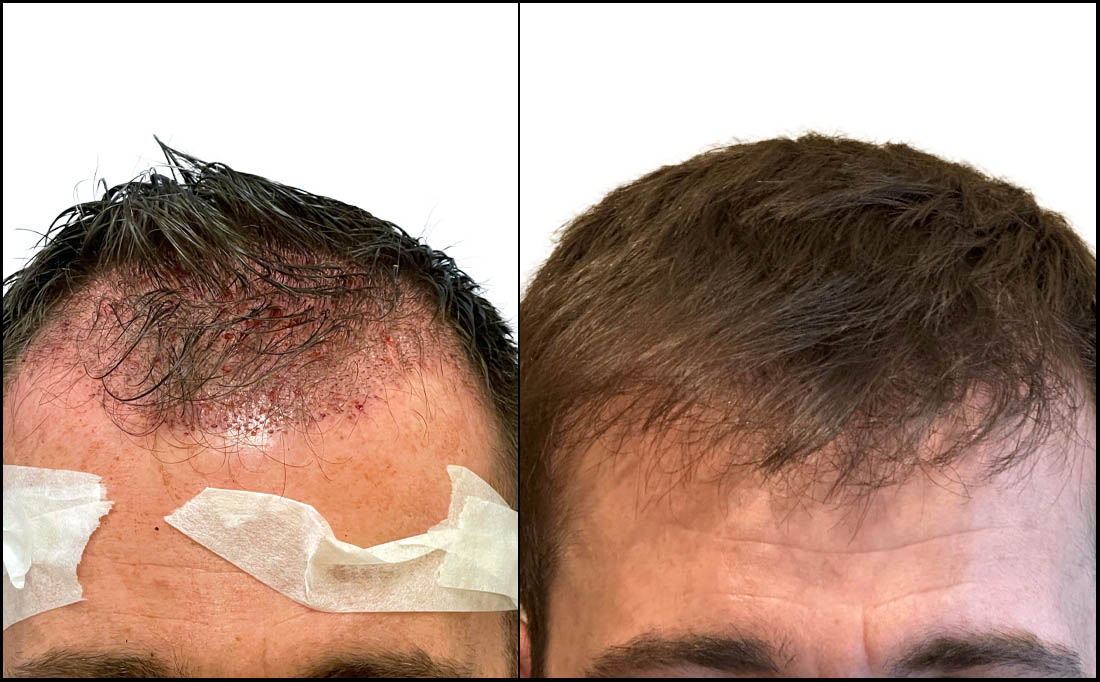 NY Hair Transplant Before and After_Male 13 NY Hair Transplant Before and After