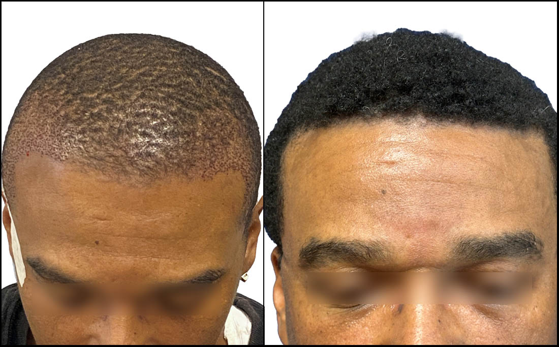 African American Before and After Hair Transplant