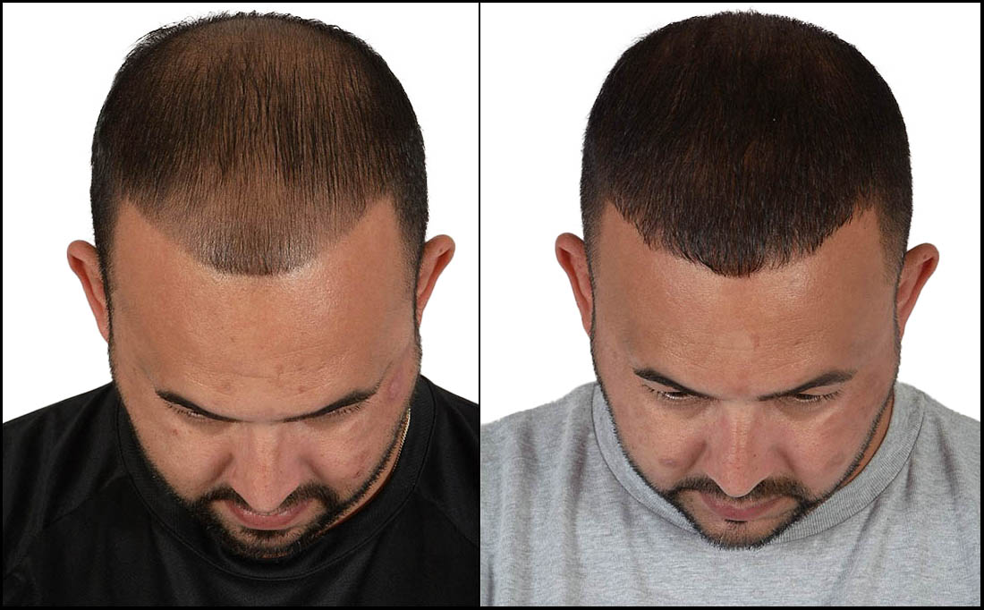 NY Hair Transplant Before and After_Male 2 Before and After