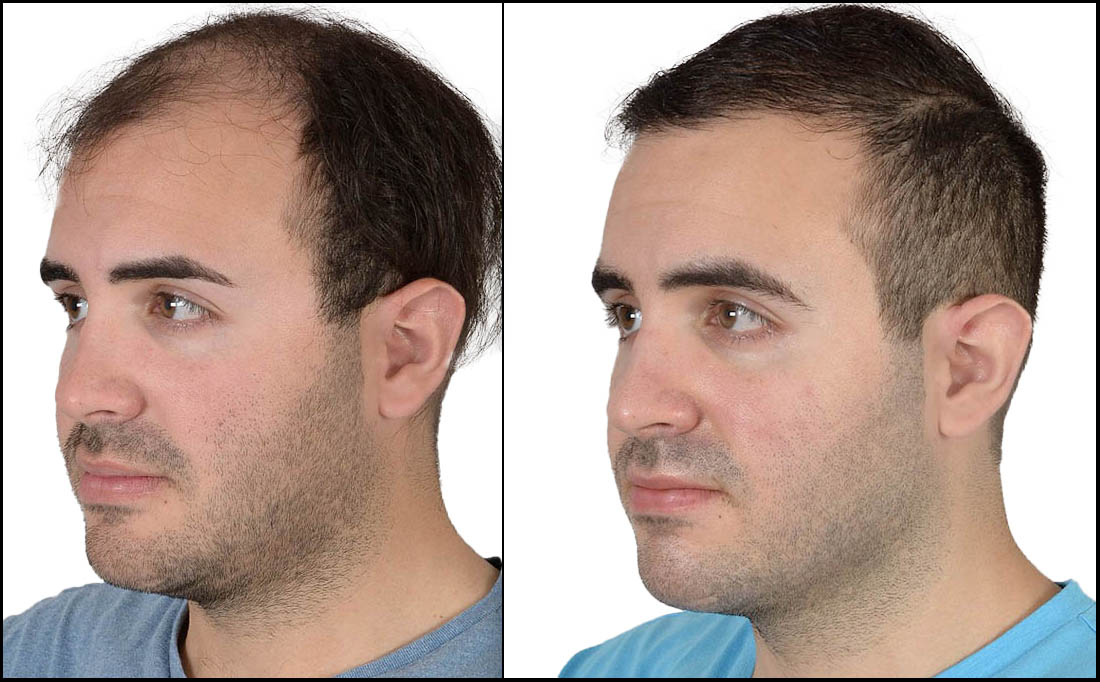 NY Hair Transplant Before and After_Male 3 NY Hair Transplant Before and After
