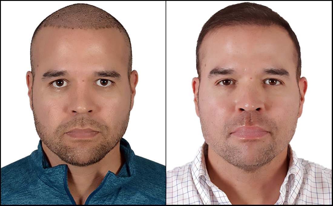 NY Hair Transplant Before and After_Male 4 Before and After