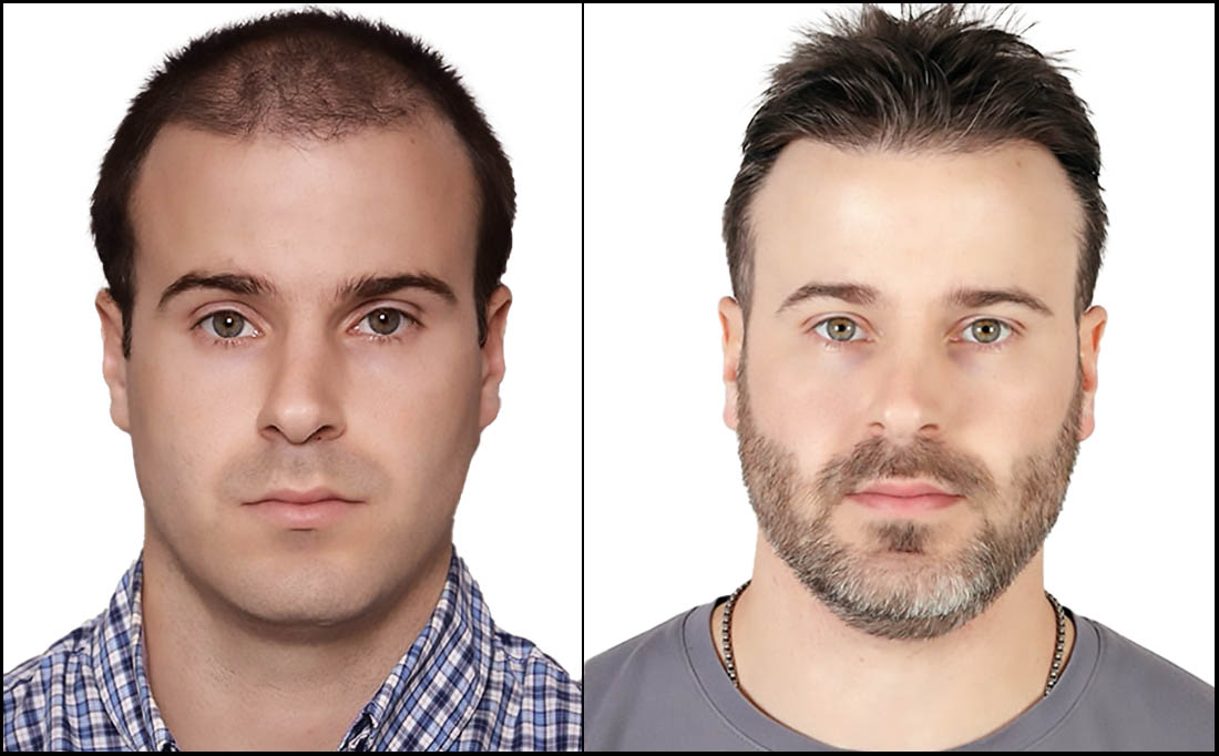 NY Hair Transplant Before and After_Male 5 NY Hair Transplant Before and After