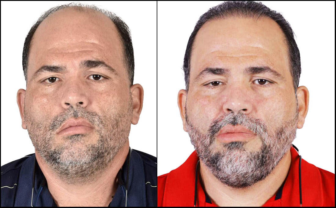 NY Hair Transplant Before and After_Male 6 NY Hair Transplant Before and After