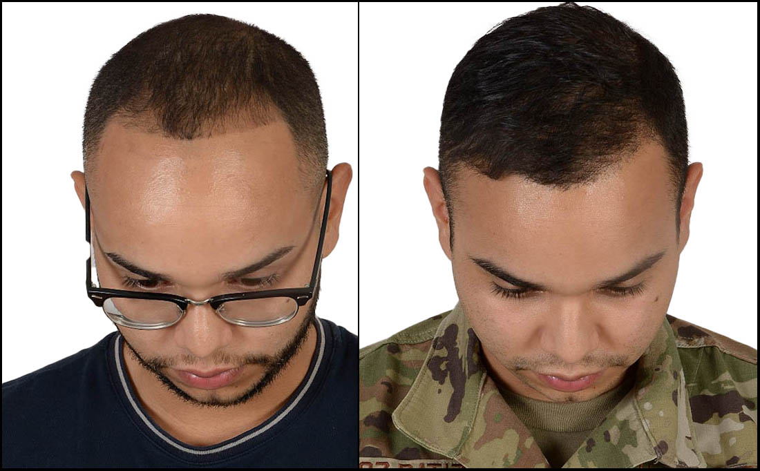 NY Hair Transplant Before and After_Male-8 NY Hair Transplant Before and After