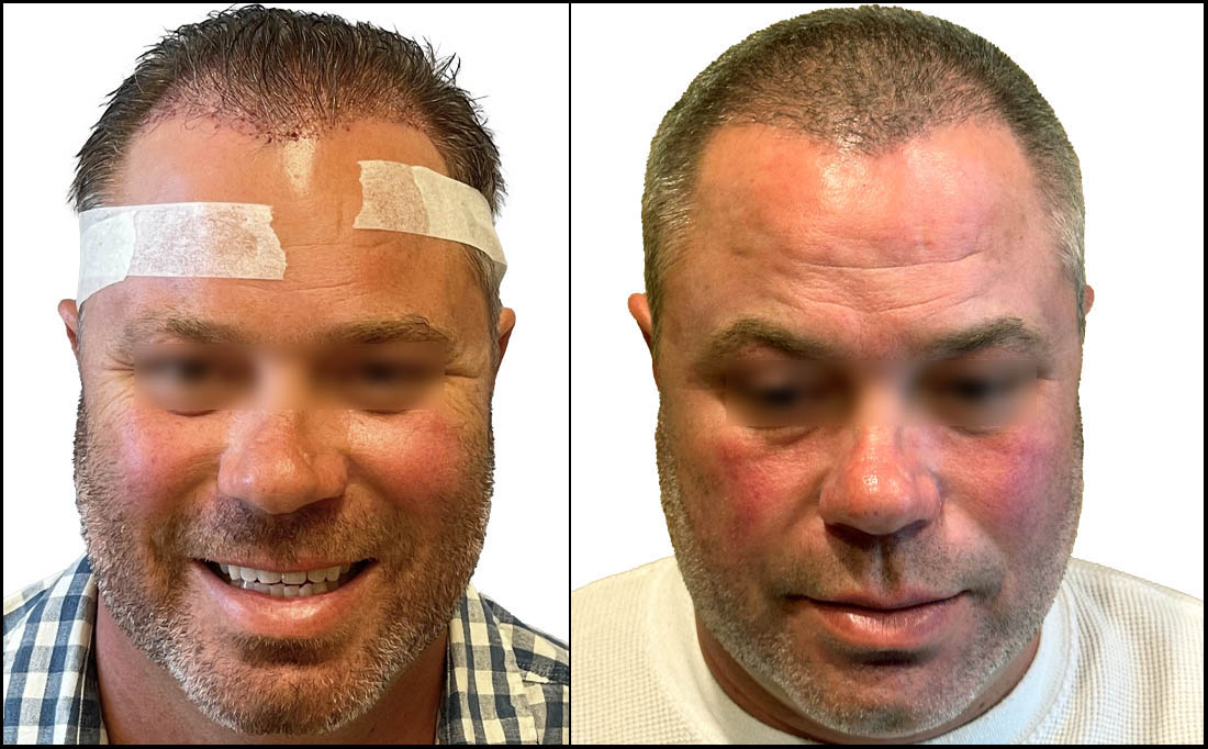 NY Hair Transplant Before and After_Male 9 NY Hair Transplant Before and After