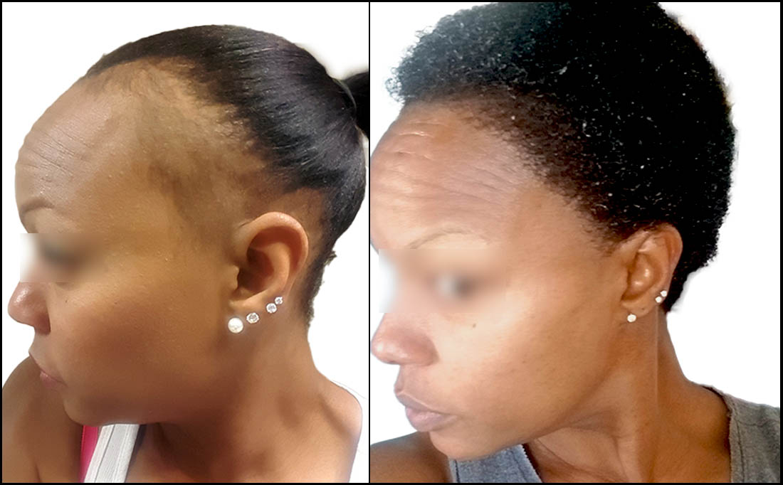 African American Before and After Hair Transplant