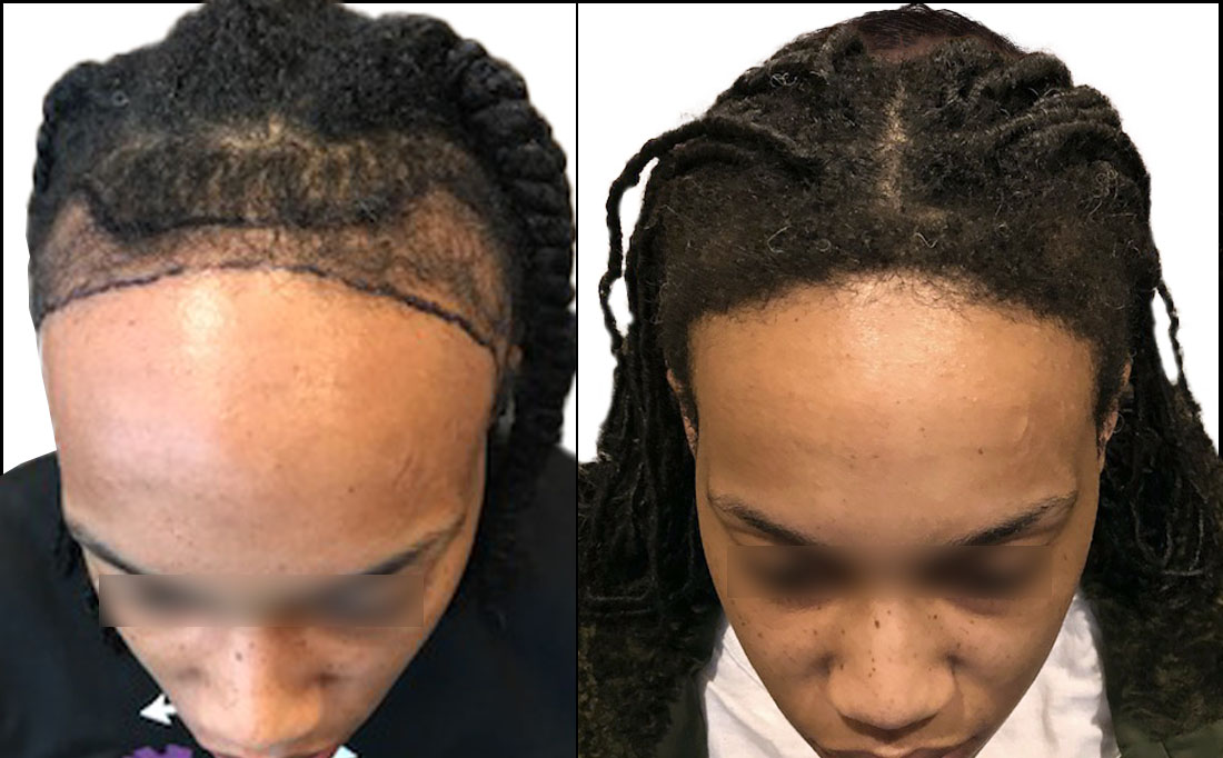 NY Hair Transplant Female Before and After_2 NY Hair Transplant Before and After